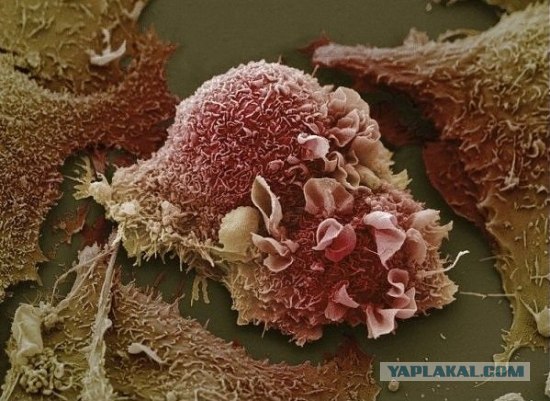 Пораженные раком клетки легких - Фотографии из глубин человеческого тела