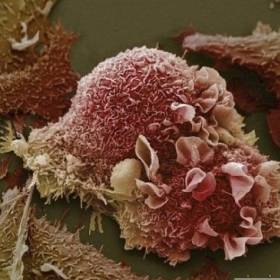 Пораженные раком клетки легких - Фотографии из глубин человеческого тела