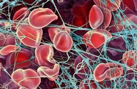 Цветной микроснимок сканирующего электронного микроскопа (СЭМ) красных кровяных клеток (эритроцитов) застрявших сетях фибрина (голубой). Когда кровеносные сосуды повреждаются, тромбоциты активизируются и провоцируют выработку фибрина. - Фотографии сделанные цветным сканирующим электронным микроскопом (СЭМ)